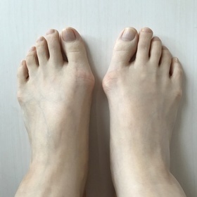 外反母趾の痛み