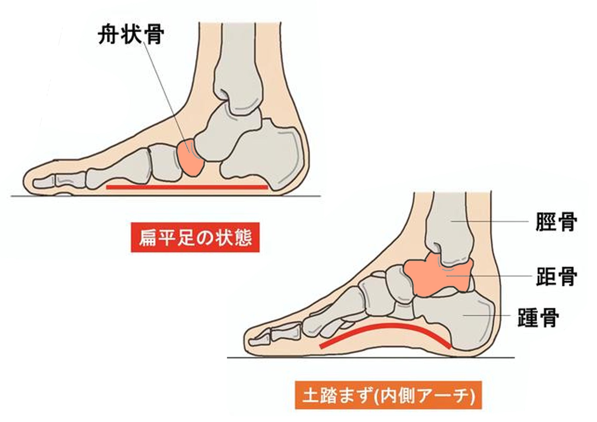足のタイプでわかる外反母趾のリスク